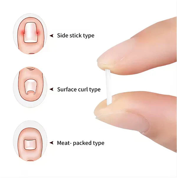 Toenail Correction Strips