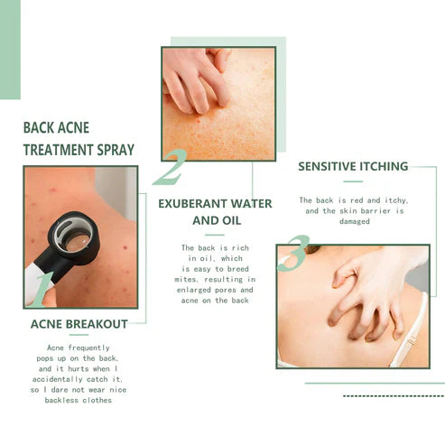 Back Acne Treatment Spray