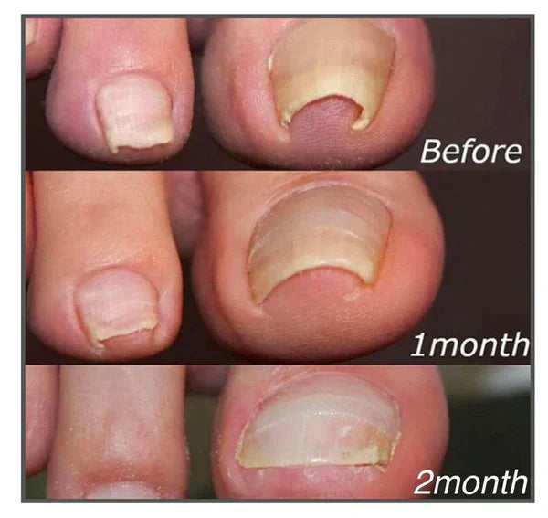 Nail Care Correction Patches